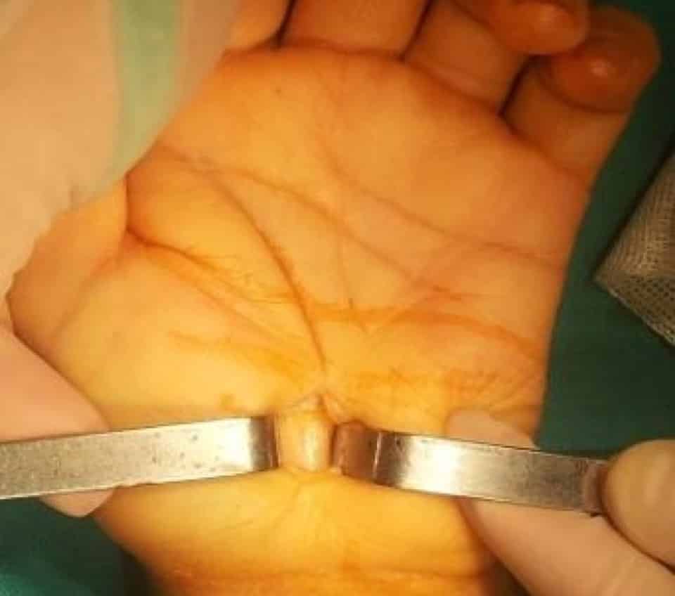 Mổ mở nhỏ điều trị HCOCT