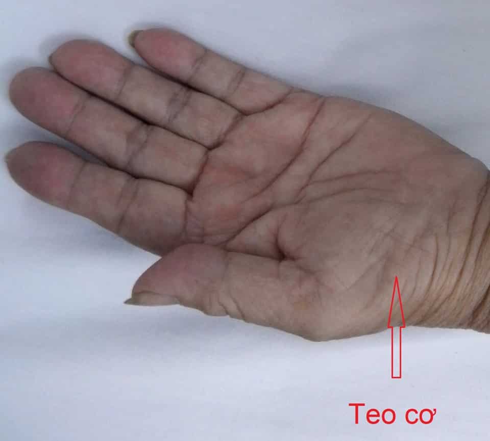 Hình ảnh teo cơ mô cái trong HCOCT