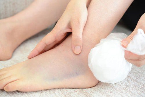 chườm đá bong gân cổ chân