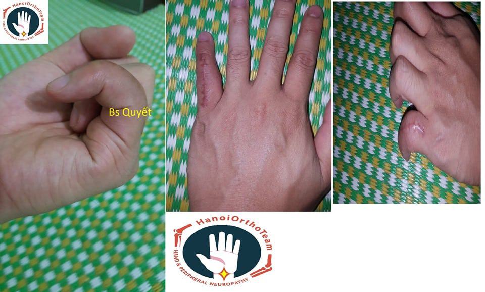 Sau mổ thay khớp bàn ngón tay 8 tuần biên độ vận động ngón rất tốt