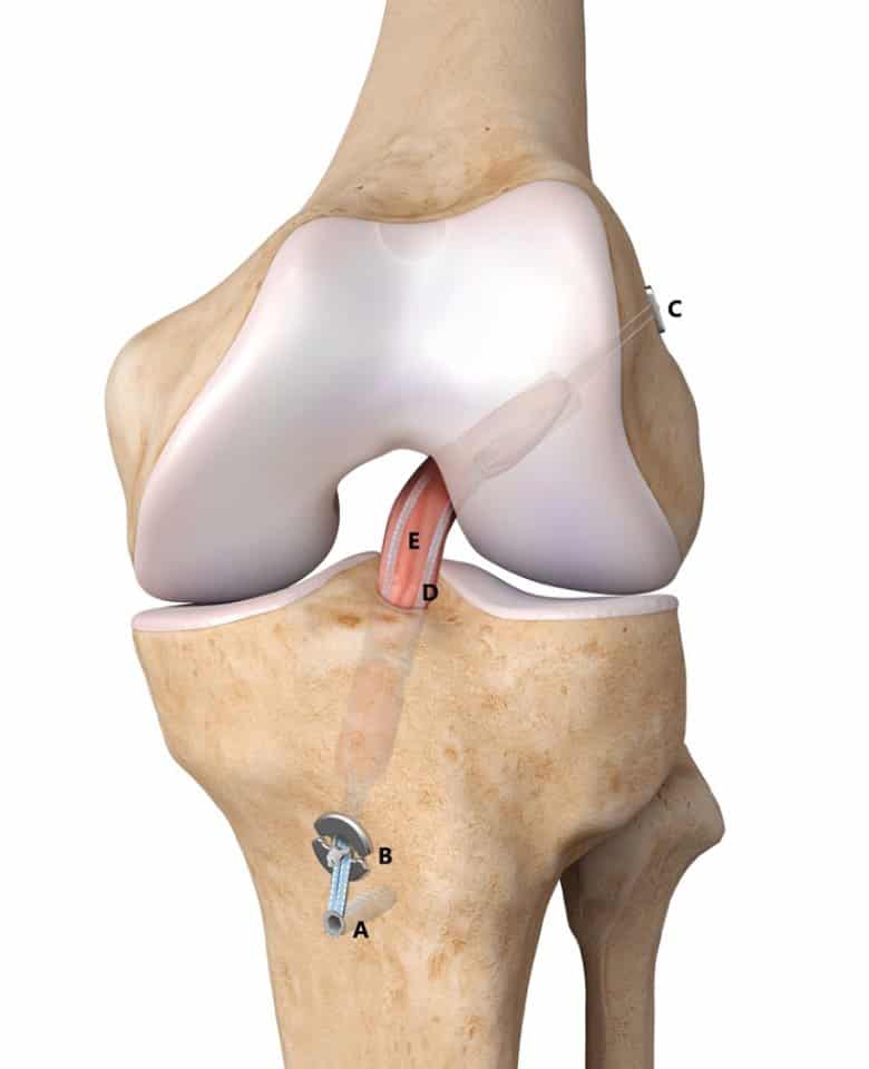 sau mổ tái tạo DCCT