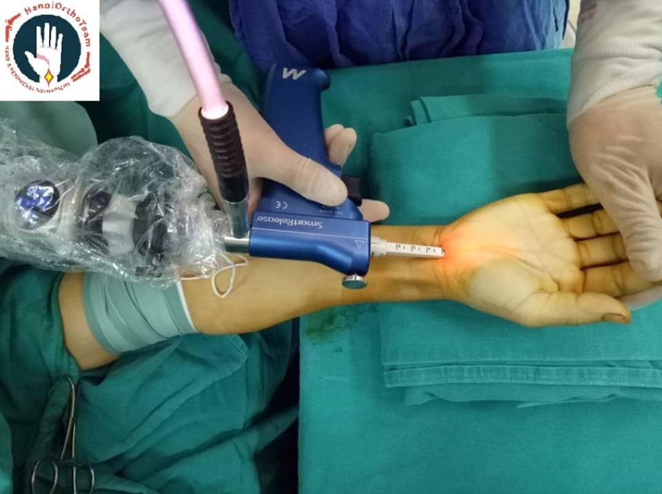 Hình ảnh nội soi điều trị Hội chứng ống cổ tay