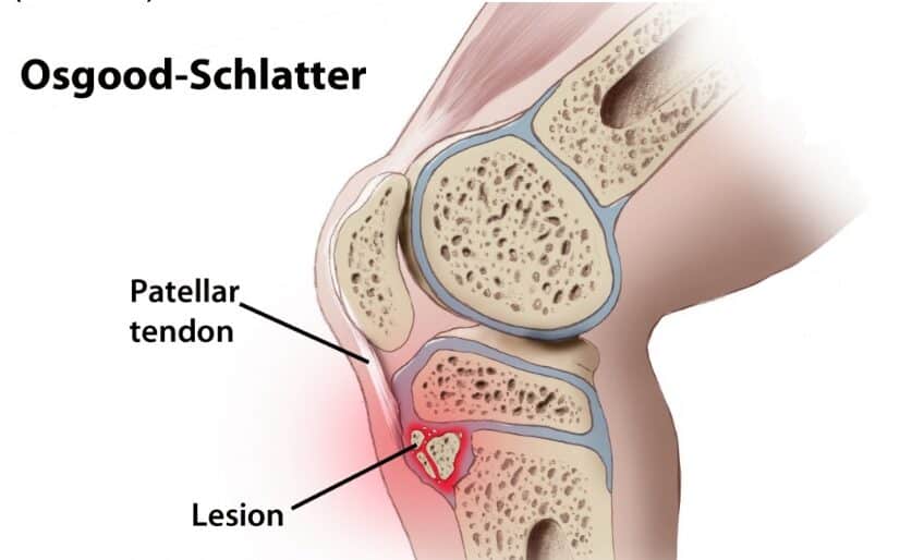 Bệnh-Osgood-Schlatter
