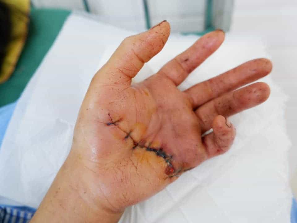 vết mổ sau phẫu thuật bàn tay