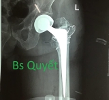 Đôi điều cần biết về phẫu thuật thay khớp háng trong gãy Liên Mấu Chuyển (LMC) xương đùi