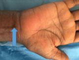 Needle Scopy – xu hướng mới điều trị Hội chứng ống cổ tay với đường mổ siêu nhỏ, không rạch da, không vết khâu
