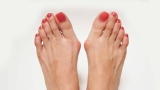 Biến dạng ngón chân halux valgus hay còn gọi là ngón chân cái vẹo ngoài
