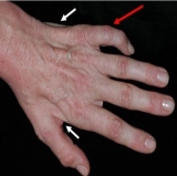 Hội chứng Guyon – một trong những nguyên nhân gây tê bì, yếu bàn tay dễ bỏ sót