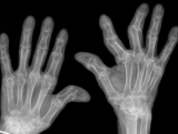 Đau cổ tay thường xuyên do nguyên nhân gì? Điều trị ra sao?